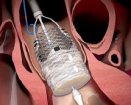 Boston Scientific Lotus Valve System | Used in Transcatheter aortic valve implantation (TAVI) | Which Medical Device